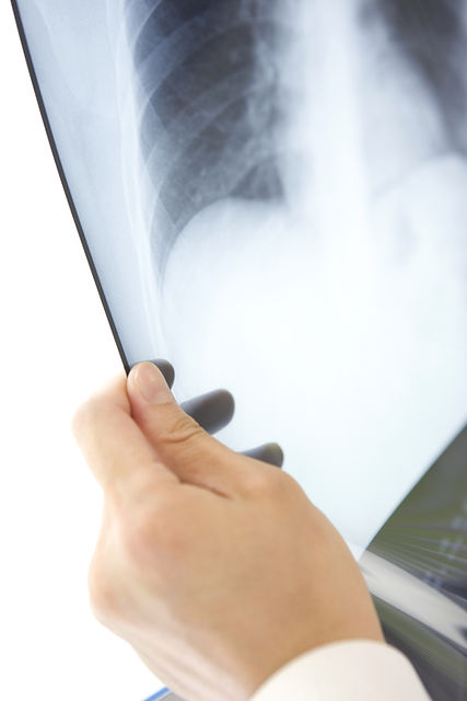 Hand holding a chest X-ray film — Oak Ridges Medical Diagnostic Imaging